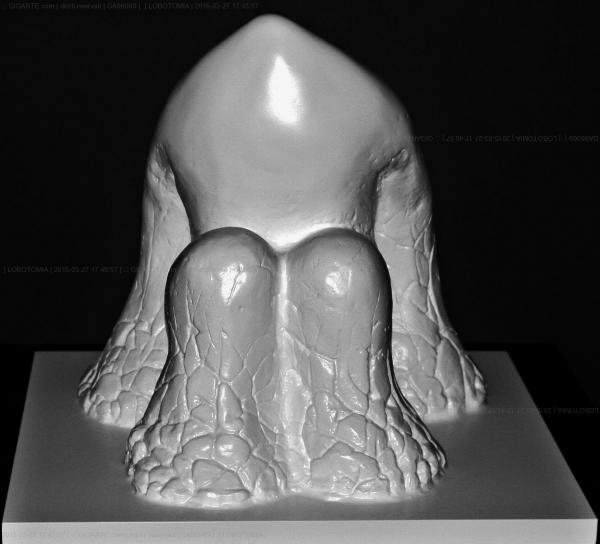 lobotomia